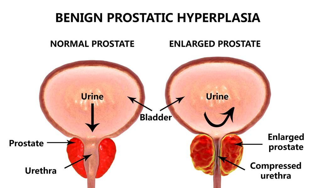 बिना ऑपरेशन प्रोस्टेट का आयुर्वेदिक इलाज - Ayurvedic Treatment Of Prostate