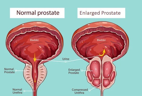 प्रोस्टेट का आयुर्वेदिक इलाज - Shrink Enlarged Prostate